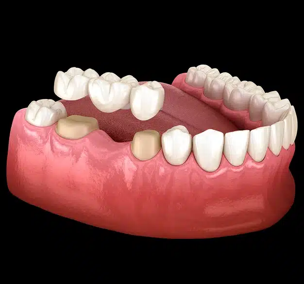 3D illustration of a dental bridge being placed over two prepared abutment teeth to replace a missing tooth