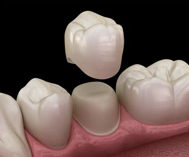 3D illustration of a dental crown being placed over a prepared molar tooth