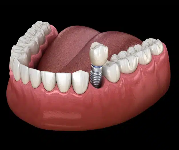 3D illustration of a single dental implant with a crown being placed into the lower jaw to replace a missing tooth