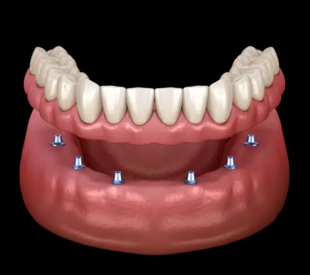 3D illustration of an implant-supported lower denture being placed onto six dental implants in the jaw