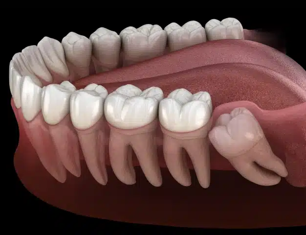 3D illustration of an impacted wisdom tooth growing sideways beneath the gums next to a molar
