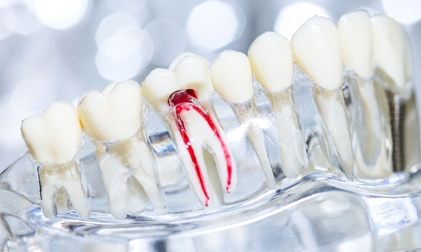 How to Maintain Your Teeth After a Root Canal
