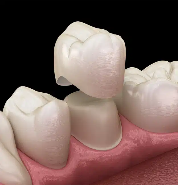 Dental Crowns In Alameda