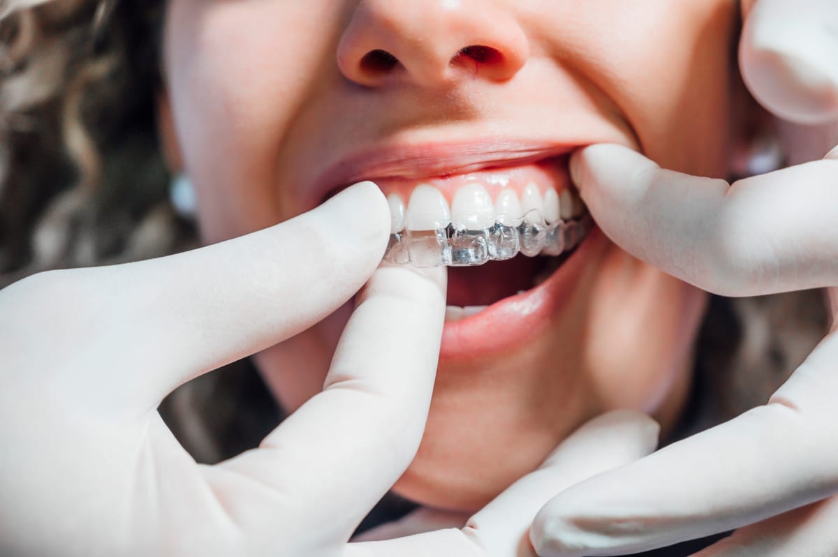 Invisalign in Alameda
