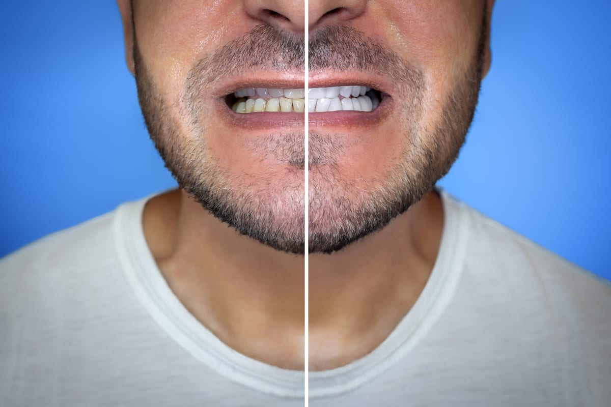 Teeth Whitening in SeaTac