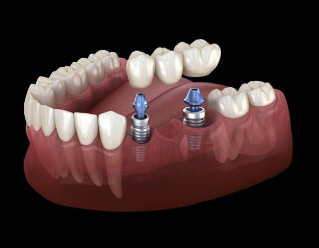 dental bridges allen tx