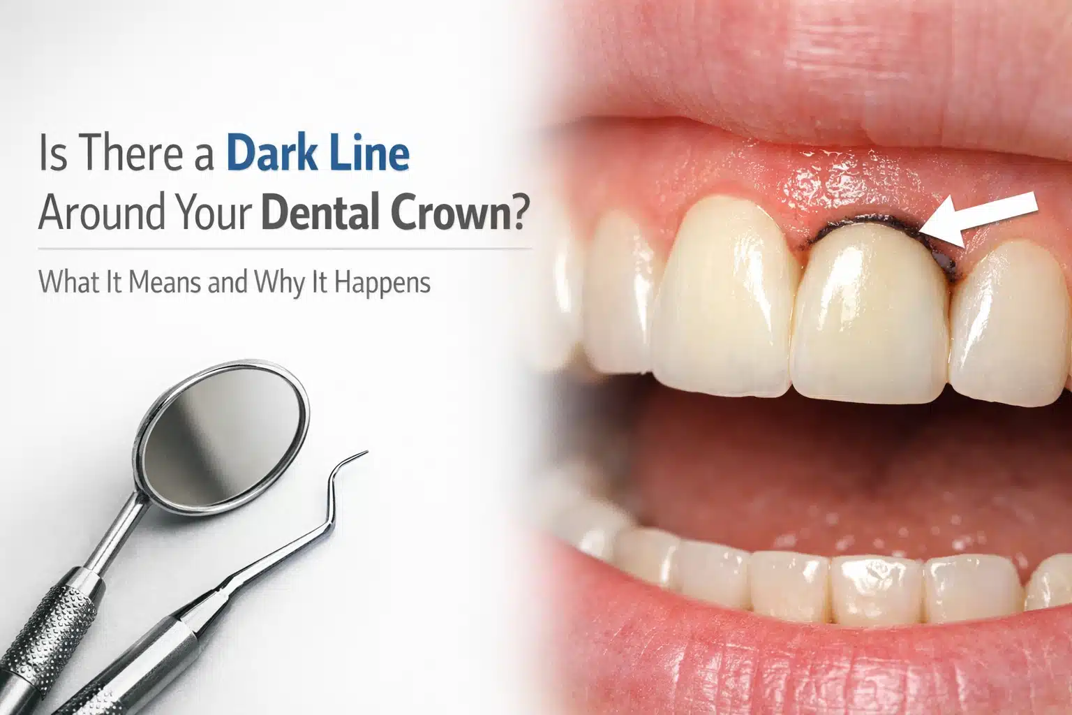 Dark line around dental crown explained