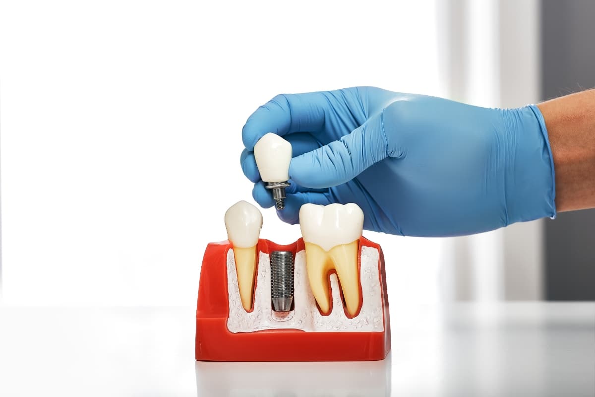 All-on-X full-arch dental implants