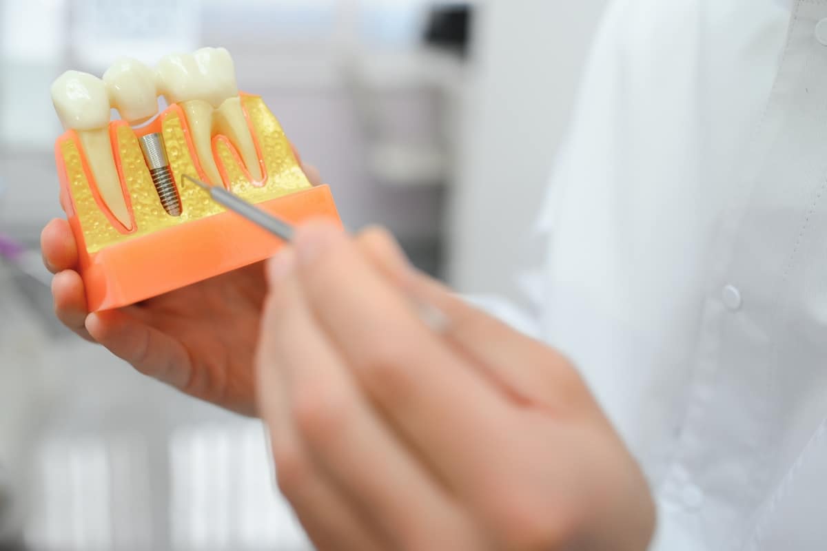 single tooth implants in Austin