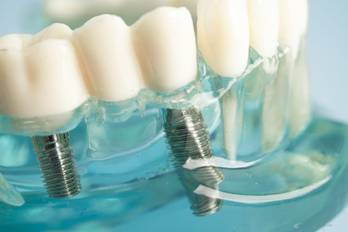 All-on-X Full-Arch Dental Implants Austin