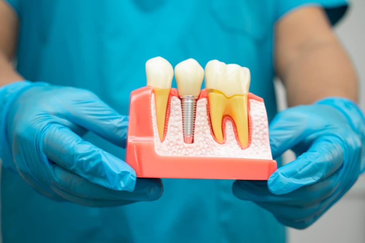 Single Dental Implants Austin