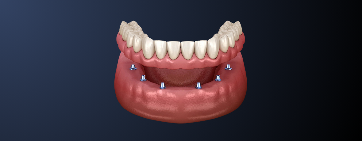 Full arch All-on-X dental implants, Austin, TX