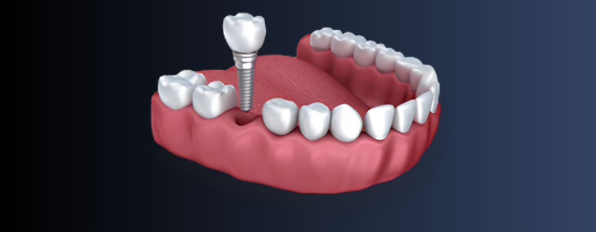 Single tooth dental implant, Austin, TX