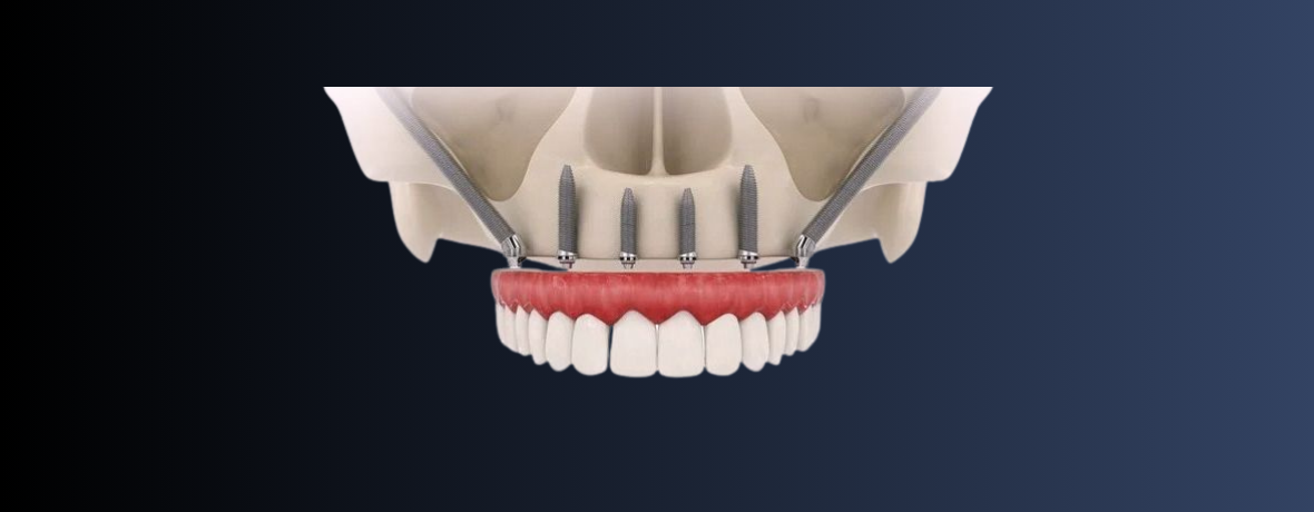 Zygomatic and pterygoid full arch implants, Austin, TX