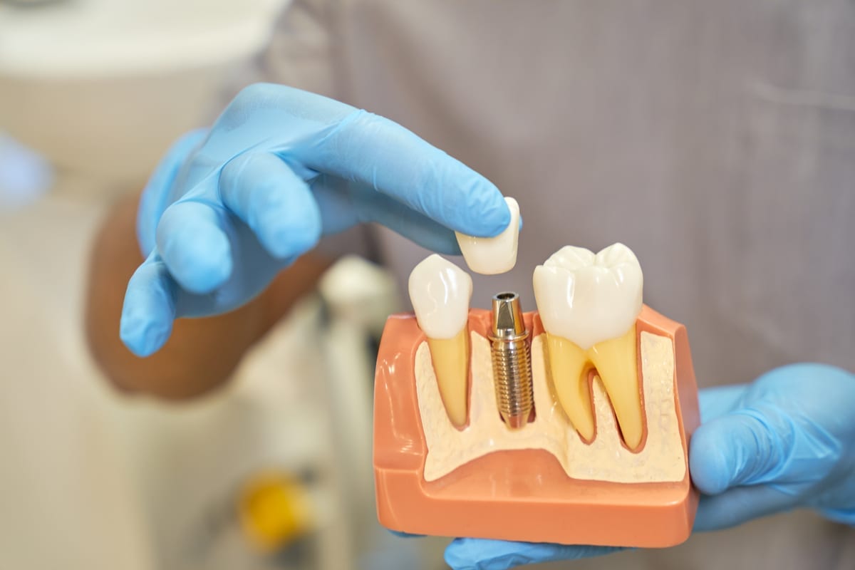 Dental Implants in Austin