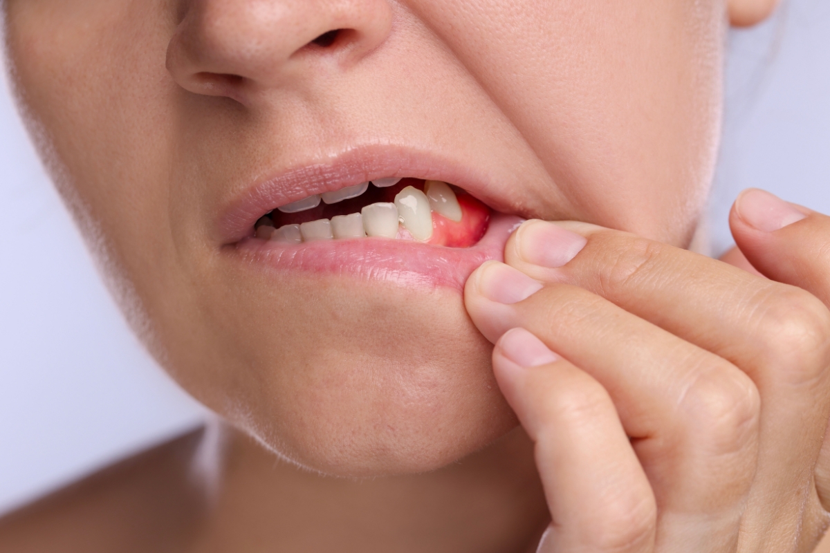 gum-disease-treatment-in-Amherst