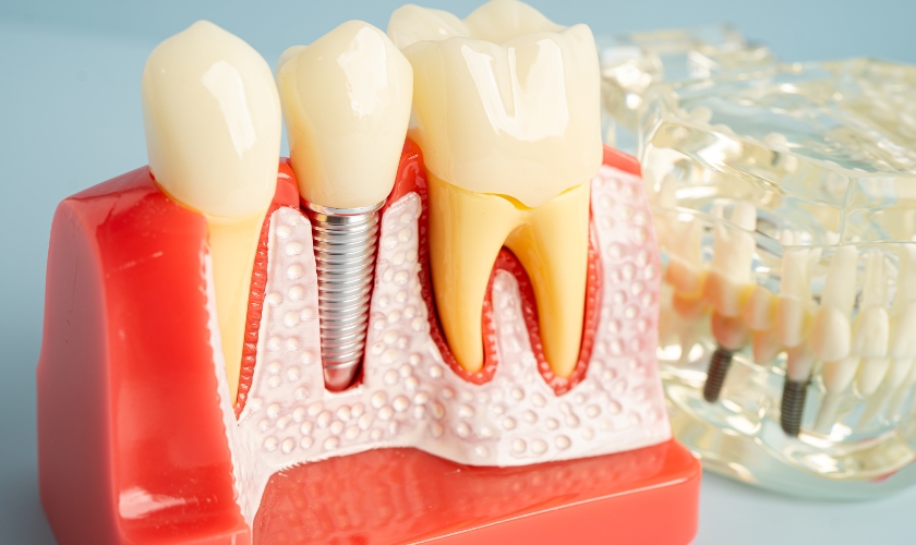 dental implants in Grants Pass