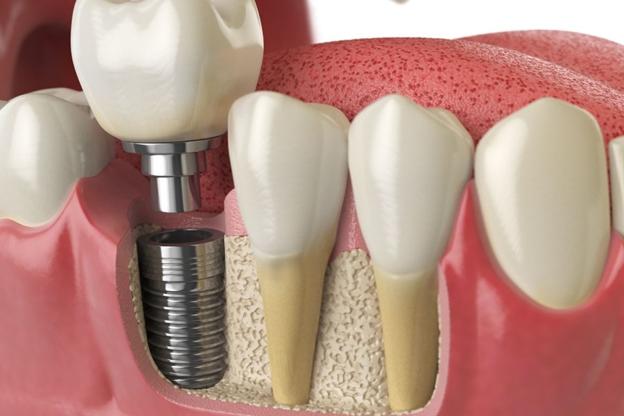 Healing After Dental Implants: Recovery Timeline for Patients