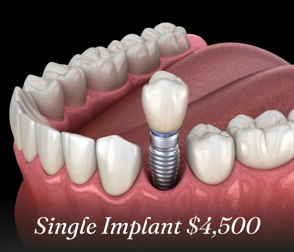 Single Implant Sale