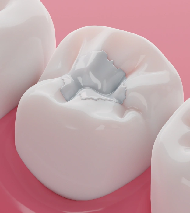 3D illustration of a tooth with composite filling material in the cavity.