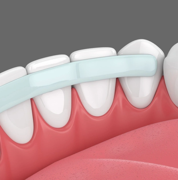 Toothbrush cleaning upper front teeth illustration for dental bonding treatment information.