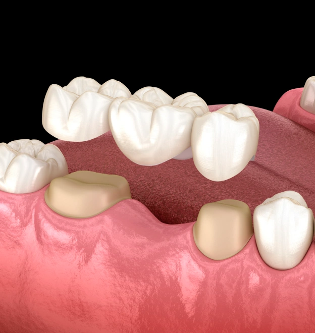 3D illustration of dental bridge restoration showing missing tooth replacement with ceramic crowns.