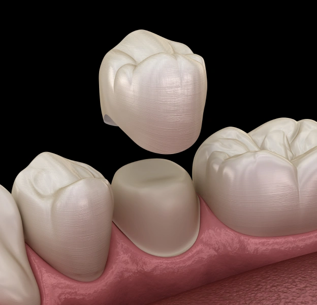 Dental crown illustration showing tooth-colored ceramic crowns on gum tissue.