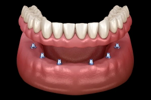 Full arch dental implants with prosthetic teeth on lower jaw model showing implant placement.