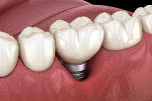Dental implant crown next to natural teeth showing replacement tooth option in Grants Pass.
