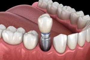 Single tooth dental implant illustration showing screw, abutment, and crown placement in jawbone.