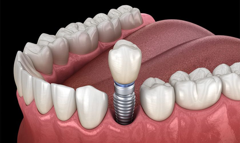 Traveling with Dental Implants