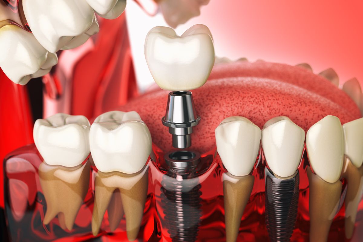 what to eat after dental implant surgery
