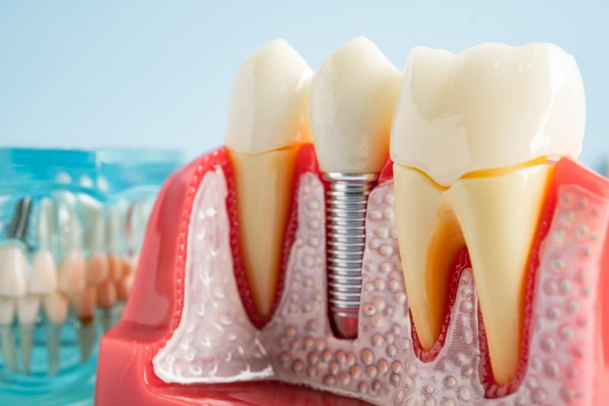dental implants Waukegan IL