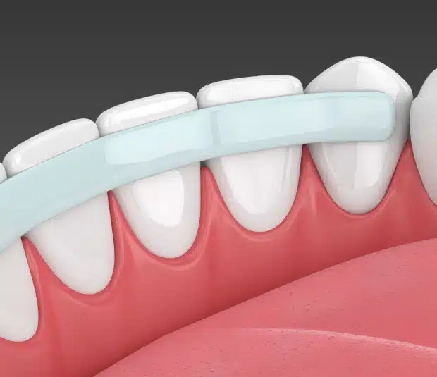 Dental Bonding