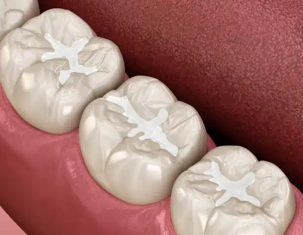Dental Sealants
