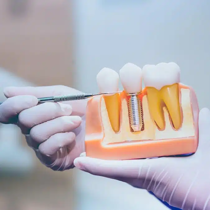dental implants in brookline