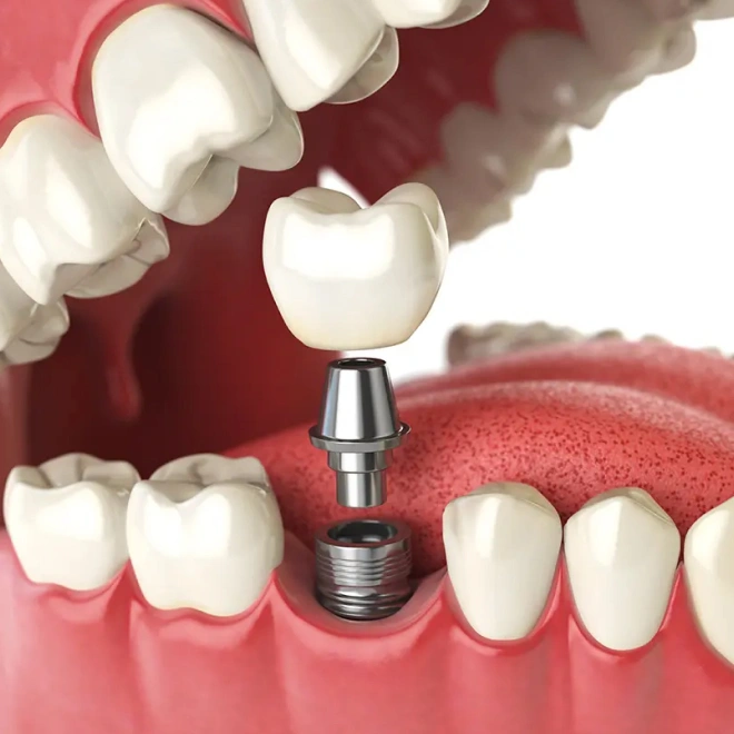 restorative implant crowns in brookline