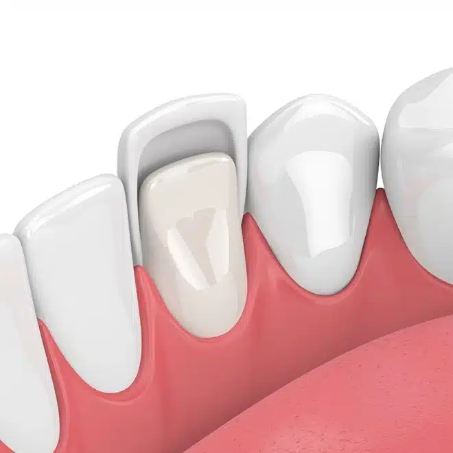 veneers brookline