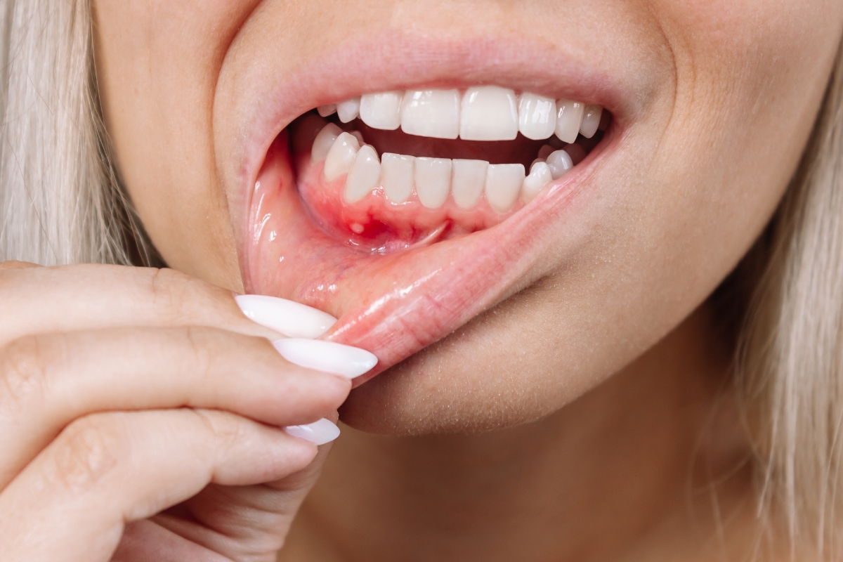 Gum Disease Treatment Bedford