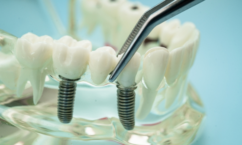 all-on-4 dental implants look real
