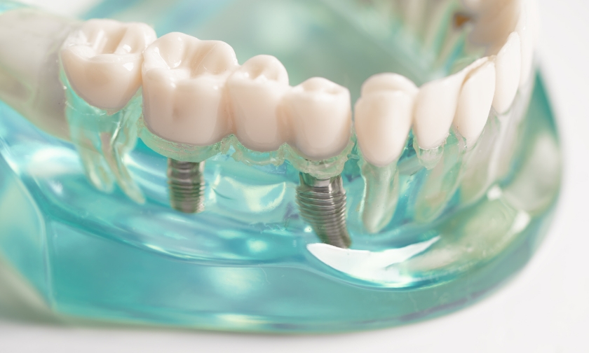 all-on-4 dental implants treatment option