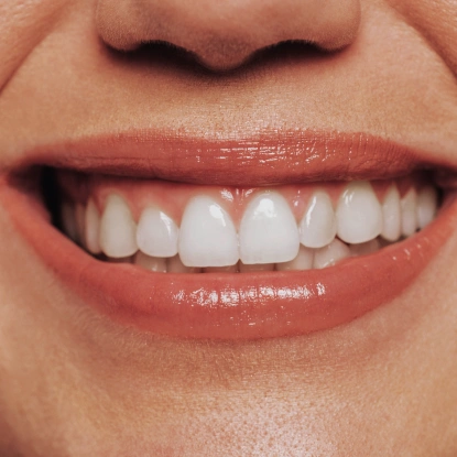 Close-up of a bright white smile showcasing professional teeth whitening results in Newnan, GA.