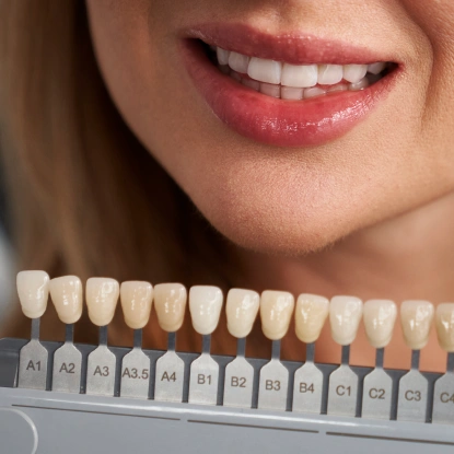 Dental veneer shade guide showing tooth color samples for cosmetic smile design.