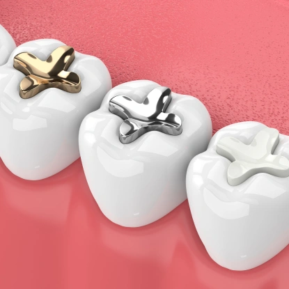 Three tooth-colored dental fillings displayed on pink background, showing gold, silver, and white restoration options.