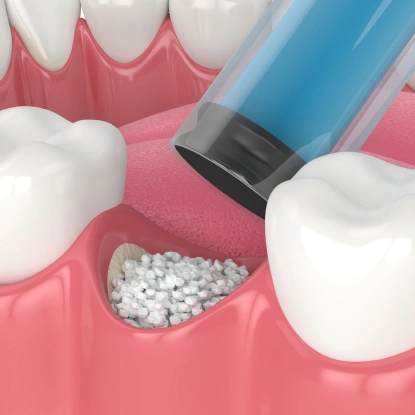 3D illustration of bone graft material being applied to dental implant site for sinus grafting procedure.