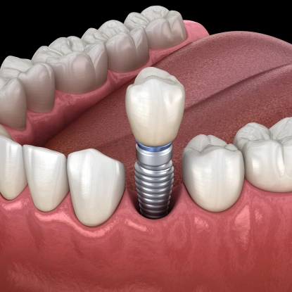 Dental implant with metal screw and crown positioned between natural teeth on gum model.