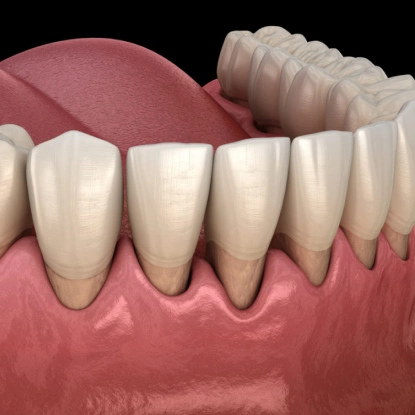 3D dental illustration showing gum disease with receding gums and tooth structure.