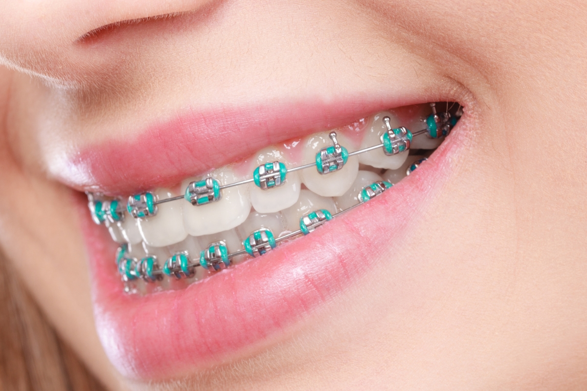 ceramic-braces-in-Glen-Allen