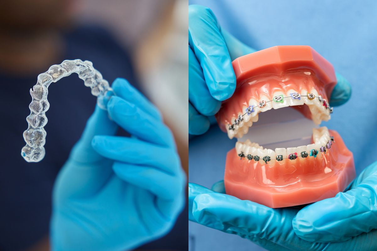 Invisalign vs. Braces