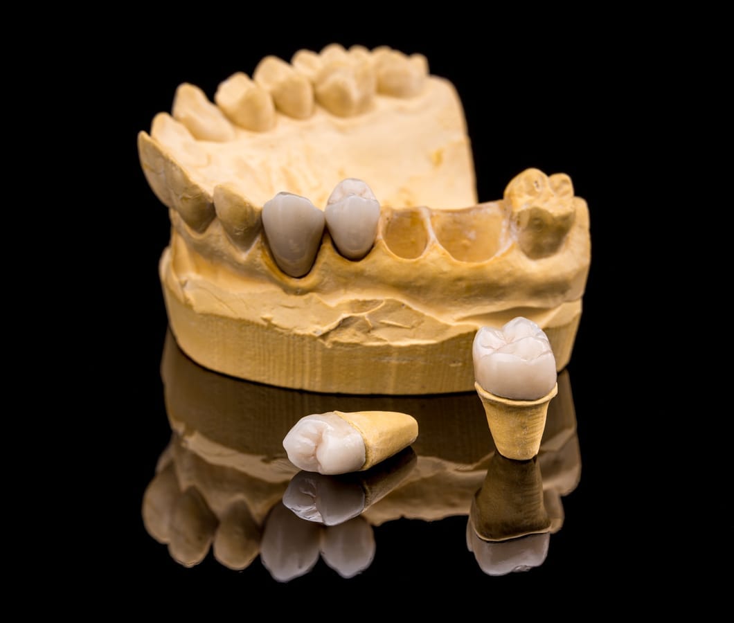 Dental Crowns in Clearwater